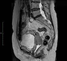 Mrt Des Beckens Bei Malignomen Radiologie Darmstadt