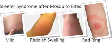 Skeeter syndrome is generally identified by the red and swollen reaction that appears after someone gets a mosquito bite, it can sometimes also those with the allergy can also try the treatments that help with any bug bite. All Skeeter Syndrome Symptoms Best Treatment Pictures Bites Treatment