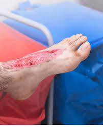 Image result for Cellulitis