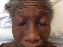 Table of Contents page: JAAD Case Reports