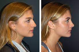 Rhinoplasty New York New York Nose Job Rhinoplasty Nyc