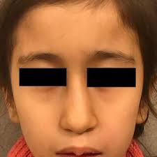 PDF) Solitary median maxillary central incisor in association with  taurodontism and oligodontia: A case report