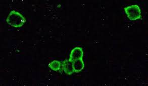 Symptoms and signs include foreign body sensation, lacrimation, photophobia, and conjunctival hyperemia. Collection Of Corneal Impression Cytology Directly On A Sterile Glass Slide For The Detection Of Viral Antigen An Inexpensive And Simple Technique For The Diagnosis Of Hsv Epithelial Keratitis A Pilot