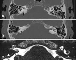 Image result for Bacterial Labyrinthitis
