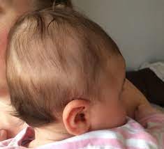 If you have postpartum hair loss, or hair loss after pregnancy, you'll notice a sudden shedding — sometimes in clumps — in the six months after you give birth. Hair Thinning On 3 5 Months Old Parenting Stack Exchange