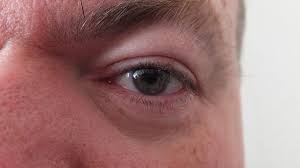 How To Make A Swollen Eyelid Go Down Wound Care Society Swollen Eyelid Swollen Eyelids Remedy Swollen Eyes