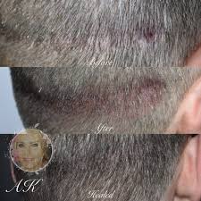 No two men are exactly the same and the cost of a men's hairline tattoo will range accordingly. Scalp Tattooing Medical Hairline Tattoo Annette Kemp