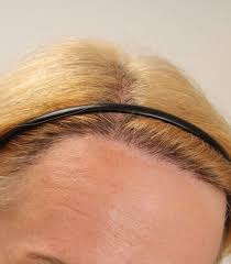 Foren sind nützliche plattformen zum austausch. Haartransplantation Vorher Nachher Bilder Erfahrungen