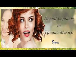 Amazing Dental Implants Done in Tijuana Mexico