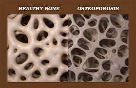 Cbd oil dosages are hard to calculate, especially when it's your first time. What The Science Says About Cbd Oil For Osteoporosis Laura S Mercantile