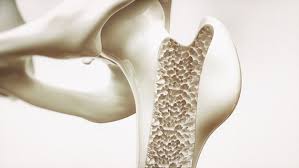 Osteoporose Wirbelbruch Op Oft Unnotig Ndr De Ratgeber Gesundheit