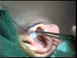 The lower jaw only finds the correct tooth position through the interlocking of the teeth. Surgical Removal Of A Damaged Temporomandibular Joint Disc Youtube