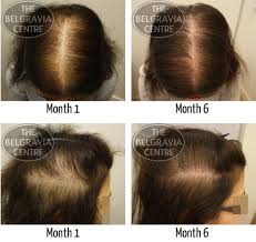 Chronic stress has also long been linked to hair loss, but the reasons weren't well understood. Treatment For Diffuse Hair Loss Aka Chronic Telogen Effluvium