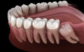 Occurrence may be single or multiple, unilateral or bilateral, erupted or impacted, and in one or both jaws. What Are Supernumerary Teeth