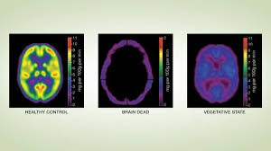 What Is The Difference Between A Coma And Brain Death Lifesource