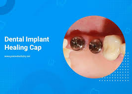 Image result for dental implant