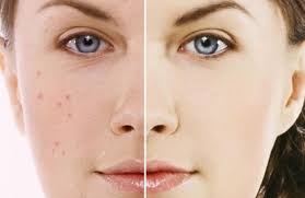 Bercak hitam kecil seperti tinta bolpoin. Cara Menghilangkan Flek Hitam Di Wajah Bekas Jerawat Medisweb