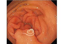 Roundworms can live in or on humans, and can cause many problems. Parasitic Worms Burrow Into Walls Of Woman S Stomach After Meal Live Science