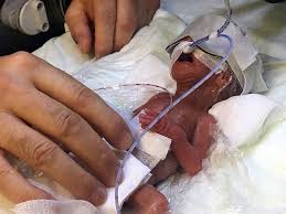 They were saved by the new mutants. After Waiting 10 Years Turkish Couple Joyfully Welcomes World S Smallest Baby Boy Daily Sabah