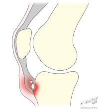 Osgood Schlatter Disease Radiology Reference Article Radiopaedia Org