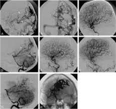 Image result for ‫آنژیوگرافی‬‎