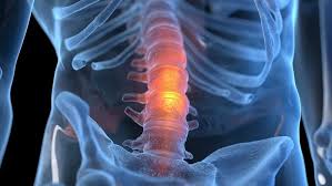 Image result for Spinal Infection
