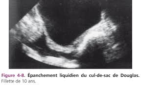 La 1ère écho le 21 novembre s'est bien passé mais pas de pronostic sur le sexe! Comment Realiser Une Echographie Pelvienne De L Enfant Et De L Adolescente