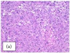 Diagnosis of pleomorphic xanthoastrocytoma was considered. Anaplastic Pleomorphic Xanthoastrocytoma Presenting With Musical Hallucination