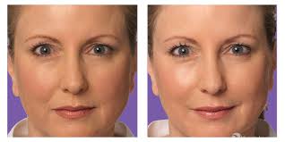 Nasolabial folds are the lines on either side of the mouth that extend from the edge of the nose to the mouth's outer corners. Juvederm Dermatology Consultants