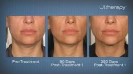 Colbert's practice in new york city, ultherapy for full face and neck costs $5,000, lower face and neck costs $3,800, and décolleté costs $2,500. Ulthera Ultherapy In Nj Neck And Face Lift Without Surgery Ethos Spa Skin And Laser Center Prlog