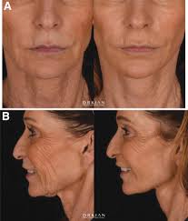 Transcutaneous Radiofrequency Microneedling in the Facial Plastic Surgeon's  Practice: A Review