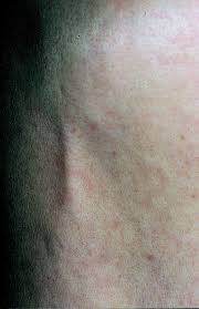 The kaohsiung journal of medical sciences. Mondor S Disease A Rare Cause Of Anterior Chest Pain Journal Of The American Academy Of Dermatology