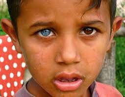 Maybe you would like to learn more about one of these? 7 Fakta Heterochromia Orang Yang Lahir Dengan Warna Mata Berbeda