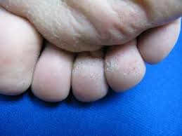 Image result for Pitting nails feet