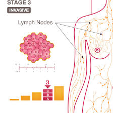 Inflammatory breast cancer is a rare type of breast cancer in which cancer cells develop in lymph vessels in the breast. Stage 3 Iii A B And C National Breast Cancer Foundation