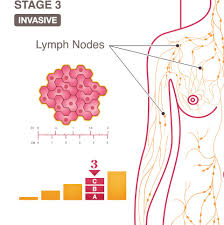Inflammatory breast cancer is medically treated by chemotherapy first. Stage 3 Iii A B And C National Breast Cancer Foundation