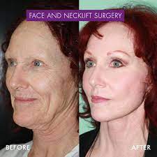 Most skilled plastic surgeons will agree that you cannot truly treat these areas with. Face Lift Surgery Cost Procedure Recovery Vida