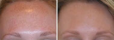 Standard ipl hair removal devices work best on lighter complexions with dark hairs. Permanent Facial Hair Removal Laser Off 64 Online Shopping Site For Fashion Lifestyle