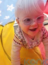 Couple 'blessed' to have three children with albinism bemoan 'rude'  comments and say 'never judge a book by its cover'