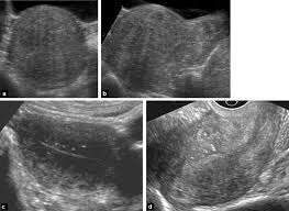 Linear striations (arrows) in the presence of a heterogeneous echo texture. An Update On Adenomyosis Sciencedirect