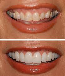 Kehilangan gigi mengartikan akan kehilangan daya hidup. Veneer Perfect Smile Arahan Lengkap Dalam Bahasa Rusia