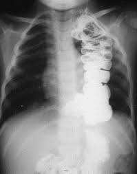 Before the availability of combination antiretroviral therapy (cart). Imaging Of The Esophagus In Children Radiologic Clinics