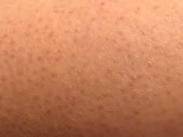 Jun 09, 2021 · keratosis pilaris is a very common skin condition in both men and women and is often spotted on the upper arms, thighs, cheeks or lower back. Keratosis Pilaris Wikipedia
