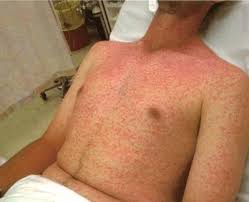 Image result for Anaphylaxis