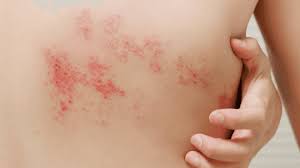 Image result for shingles