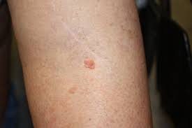 In the united states, it's estimated that doctors diagnose over 100,000 new skin cancer cases each year. Squamous Cell Carcinoma Causes And Treatment Dermatology Consultants