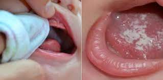 Waspadai oral thrush pada bayi, infeksi mulut yang disebabkan oleh jamur. Jangkitan Kandida Atau Oral Thrush Apa Ibu Bapa Perlu Tahu Theasianparent Malaysia