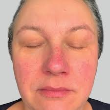 PDF) The application of thermolysis and sonophoresis for vascular closure.  Case report