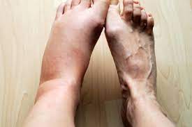 Hello and welcome to hcm, swollen feet can occur after hanging the legs for a long period of time. 10 Causes For Swollen Feet Why Your Feet Ankles Legs Swell