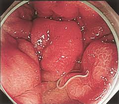 アニサキスはなぜ痛いのか Dr 渡ブログ 部屋とyシャツと国試
